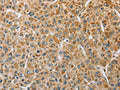 The image on the left is immunohistochemistry of paraffin-embedded Human liver cancer tissue using CSB-PA283369(MIP Antibody) at dilution 1/50, on the right is treated with fusion protein. (Original magnification: ×200)