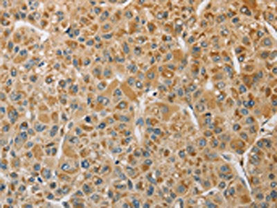The image on the left is immunohistochemistry of paraffin-embedded Human liver cancer tissue using CSB-PA283369(MIP Antibody) at dilution 1/50, on the right is treated with fusion protein. (Original magnification: ×200)