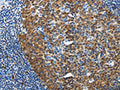 The image on the left is immunohistochemistry of paraffin-embedded Human tonsil tissue using CSB-PA283493(DCK Antibody) at dilution 1/20, on the right is treated with fusion protein. (Original magnification: ×200)