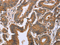 The image on the left is immunohistochemistry of paraffin-embedded Human colon cancer tissue using CSB-PA283664(EPDR1 Antibody) at dilution 1/20, on the right is treated with fusion protein. (Original magnification: ×200)