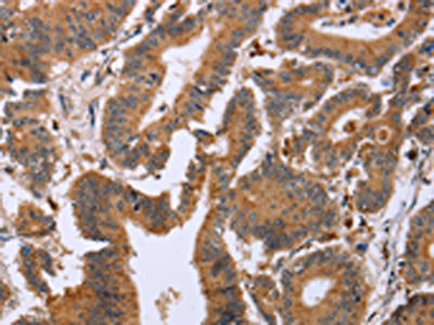 The image on the left is immunohistochemistry of paraffin-embedded Human colon cancer tissue using CSB-PA283664(EPDR1 Antibody) at dilution 1/20, on the right is treated with fusion protein. (Original magnification: ×200)