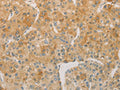 The image on the left is immunohistochemistry of paraffin-embedded Human liver cancer tissue using CSB-PA283716(ACSL4 Antibody) at dilution 1/60, on the right is treated with fusion protein. (Original magnification: ×200)