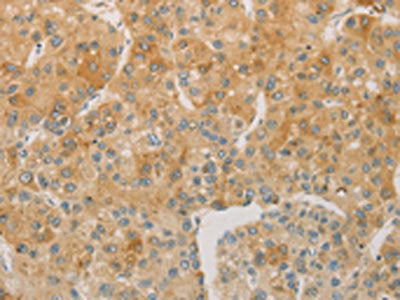 The image on the left is immunohistochemistry of paraffin-embedded Human liver cancer tissue using CSB-PA283716(ACSL4 Antibody) at dilution 1/60, on the right is treated with fusion protein. (Original magnification: ×200)