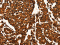 The image on the left is immunohistochemistry of paraffin-embedded Human breast cancer tissue using CSB-PA283839(CUEDC2 Antibody) at dilution 1/50, on the right is treated with fusion protein. (Original magnification: ×200)