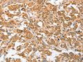 The image on the left is immunohistochemistry of paraffin-embedded Human thyroid cancer tissue using CSB-PA283856(CDR2 Antibody) at dilution 1/30, on the right is treated with fusion protein. (Original magnification: ×200)