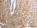The image on the left is immunohistochemistry of paraffin-embedded Human cervical cancer tissue using CSB-PA283902(RAD51 Antibody) at dilution 1/30, on the right is treated with synthetic peptide. (Original magnification: ×200)