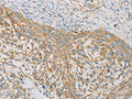 The image on the left is immunohistochemistry of paraffin-embedded Human cervical cancer tissue using CSB-PA284388(REN Antibody) at dilution 1/40, on the right is treated with fusion protein. (Original magnification: ×200)