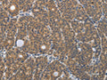 The image on the left is immunohistochemistry of paraffin-embedded Human thyroid cancer tissue using CSB-PA285011(PGR Antibody) at dilution 1/30, on the right is treated with synthetic peptide. (Original magnification: ×200)