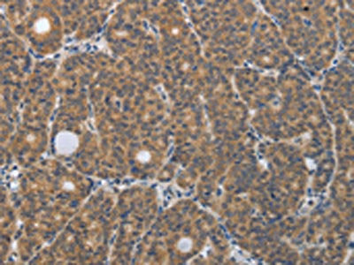 The image on the left is immunohistochemistry of paraffin-embedded Human thyroid cancer tissue using CSB-PA285011(PGR Antibody) at dilution 1/30, on the right is treated with synthetic peptide. (Original magnification: ×200)