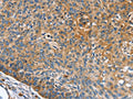 The image on the left is immunohistochemistry of paraffin-embedded Human esophagus cancer tissue using CSB-PA285156(INS Antibody) at dilution 1/35, on the right is treated with synthetic peptide. (Original magnification: ×200)