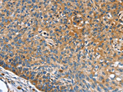 The image on the left is immunohistochemistry of paraffin-embedded Human esophagus cancer tissue using CSB-PA285156(INS Antibody) at dilution 1/35, on the right is treated with synthetic peptide. (Original magnification: ×200)