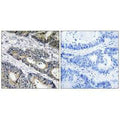 Immunohistochemistry analysis of paraffin-embedded human colon carcinoma tissue using GLB1L3 antibody.
