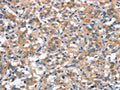 The image on the left is immunohistochemistry of paraffin-embedded Human thyroid cancer tissue using CSB-PA285547(ANP32C Antibody) at dilution 1/30, on the right is treated with synthetic peptide. (Original magnification: ×200)