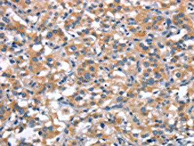 The image on the left is immunohistochemistry of paraffin-embedded Human thyroid cancer tissue using CSB-PA285547(ANP32C Antibody) at dilution 1/30, on the right is treated with synthetic peptide. (Original magnification: ×200)