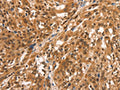 The image on the left is immunohistochemistry of paraffin-embedded Human esophagus cancer tissue using CSB-PA285746(CCNE2 Antibody) at dilution 1/25, on the right is treated with synthetic peptide. (Original magnification: ×200)