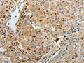 The image on the left is immunohistochemistry of paraffin-embedded Human cervical cancer tissue using CSB-PA285910(F13A1 Antibody) at dilution 1/15, on the right is treated with fusion protein. (Original magnification: X200)