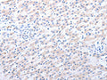 The image on the left is immunohistochemistry of paraffin-embedded Human liver cancer tissue using CSB-PA286031(ALDH1A1/ALDH1A2/ALDH1A3 Antibody) at dilution 1/40, on the right is treated with fusion protein. (Original magnification: ×200)