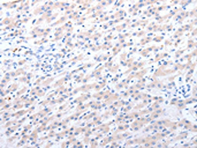 The image on the left is immunohistochemistry of paraffin-embedded Human liver cancer tissue using CSB-PA286031(ALDH1A1/ALDH1A2/ALDH1A3 Antibody) at dilution 1/40, on the right is treated with fusion protein. (Original magnification: ×200)