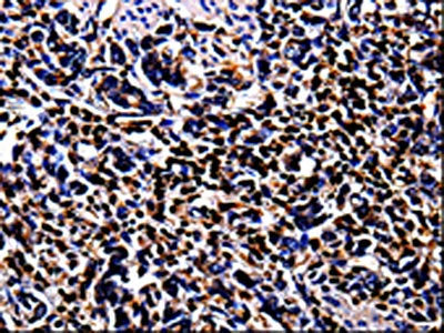 The image on the left is immunohistochemistry of paraffin-embedded Human stomach cancer tissue using CSB-PA286071(S100A4 Antibody) at dilution 1/100, on the right is treated with fusion protein. (Original magnification: ×200)