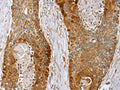 The image on the left is immunohistochemistry of paraffin-embedded Human esophagus cancer tissue using CSB-PA286125(LMO4 Antibody) at dilution 1/20, on the right is treated with fusion protein. (Original magnification: ×200)