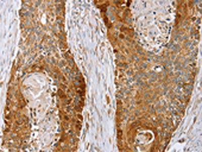 The image on the left is immunohistochemistry of paraffin-embedded Human esophagus cancer tissue using CSB-PA286125(LMO4 Antibody) at dilution 1/20, on the right is treated with fusion protein. (Original magnification: ×200)
