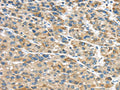 The image on the left is immunohistochemistry of paraffin-embedded Human liver cancer tissue using CSB-PA286159(GLP2R Antibody) at dilution 1/30, on the right is treated with fusion protein. (Original magnification: ×200)
