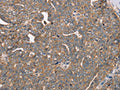 The image on the left is immunohistochemistry of paraffin-embedded Human cervical cancer tissue using CSB-PA286186(FAIM2 Antibody) at dilution 1/40, on the right is treated with fusion protein. (Original magnification: ×200)