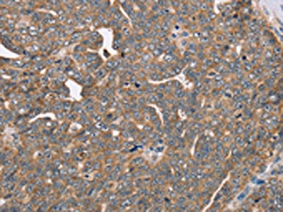 The image on the left is immunohistochemistry of paraffin-embedded Human cervical cancer tissue using CSB-PA286186(FAIM2 Antibody) at dilution 1/40, on the right is treated with fusion protein. (Original magnification: ×200)