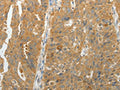 The image on the left is immunohistochemistry of paraffin-embedded Human ovarian cancer tissue using CSB-PA286198(MAP4K5 Antibody) at dilution 1/10, on the right is treated with fusion protein. (Original magnification: ×200)