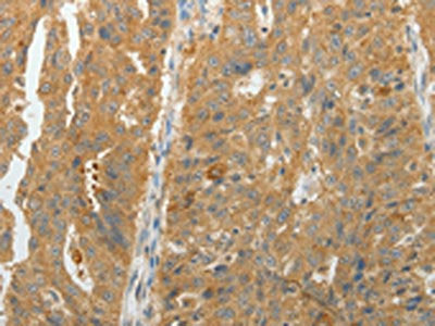 The image on the left is immunohistochemistry of paraffin-embedded Human ovarian cancer tissue using CSB-PA286198(MAP4K5 Antibody) at dilution 1/10, on the right is treated with fusion protein. (Original magnification: ×200)