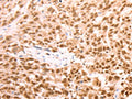 The image on the left is immunohistochemistry of paraffin-embedded Human esophagus cancer tissue using CSB-PA286404(AMD1 Antibody) at dilution 1/25, on the right is treated with synthetic peptide. (Original magnification: ×200)