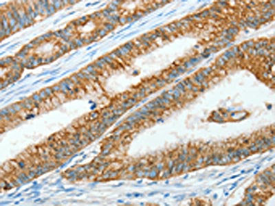 The image on the left is immunohistochemistry of paraffin-embedded Human colon cancer tissue using CSB-PA286707(AGR3 Antibody) at dilution 1/15, on the right is treated with fusion protein. (Original magnification: ×200)