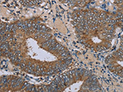 The image on the left is immunohistochemistry of paraffin-embedded Human colon cancer tissue using CSB-PA286863(IFRD1 Antibody) at dilution 1/30, on the right is treated with fusion protein. (Original magnification: ×200)