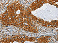The image on the left is immunohistochemistry of paraffin-embedded Human cervical cancer tissue using CSB-PA286864(SEPT9 Antibody) at dilution 1/25, on the right is treated with fusion protein. (Original magnification: ×200)