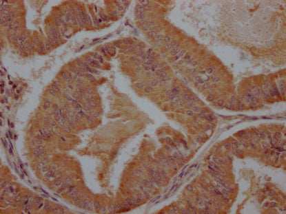 IHC image of CSB-PA28699A0Rb diluted at 1:100 and staining in paraffin-embedded human endometrial cancer performed on a Leica BondTM system. After dewaxing and hydration, antigen retrieval was mediated by high pressure in a citrate buffer (pH 6.0). Section was blocked with 10% normal goat serum 30min at RT. Then primary antibody (1% BSA) was incubated at 4°C overnight. The primary is detected by a Goat anti-rabbit polymer IgG labeled by HRP and visualized using 0.05% DAB.