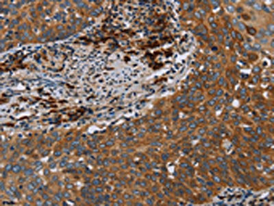 The image on the left is immunohistochemistry of paraffin-embedded Human cervical cancer tissue using CSB-PA287045(HYAL3 Antibody) at dilution 1/40, on the right is treated with fusion protein. (Original magnification: ×200)