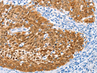 The image on the left is immunohistochemistry of paraffin-embedded Human cervical cancer tissue using CSB-PA287048(IRF6 Antibody) at dilution 1/50, on the right is treated with fusion protein. (Original magnification: ×200)