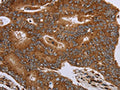 The image on the left is immunohistochemistry of paraffin-embedded Human colon cancer tissue using CSB-PA287281(HSD17B4 Antibody) at dilution 1/20, on the right is treated with fusion protein. (Original magnification: ×200)