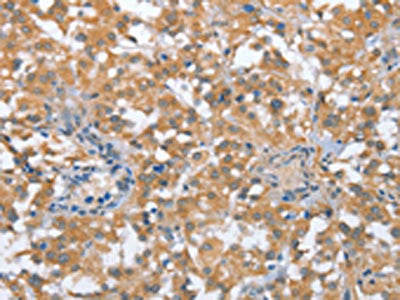 The image on the left is immunohistochemistry of paraffin-embedded Human thyroid cancer tissue using CSB-PA287469(TP53BP2 Antibody) at dilution 1/35, on the right is treated with fusion protein. (Original magnification: ×200)