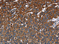 The image on the left is immunohistochemistry of paraffin-embedded Human lung cancer tissue using CSB-PA287660(FCGR3A Antibody) at dilution 1/40, on the right is treated with fusion protein. (Original magnification: ×200)