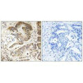 Immunohistochemistry analysis of paraffin-embedded human colon carcinoma tissue using PIK3R5 antibody.
