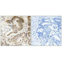 Immunohistochemistry analysis of paraffin-embedded human colon carcinoma tissue using PIK3R5 antibody.