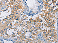 The image on the left is immunohistochemistry of paraffin-embedded Human thyroid cancer tissue using CSB-PA288252(ATP6AP2 Antibody) at dilution 1/40, on the right is treated with fusion protein. (Original magnification: ×200)