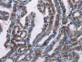 The image on the left is immunohistochemistry of paraffin-embedded Human thyroid cancer tissue using CSB-PA288314(FHIT Antibody) at dilution 1/25, on the right is treated with fusion protein. (Original magnification: ×200)
