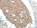 The image on the left is immunohistochemistry of paraffin-embedded Human breast cancer tissue using CSB-PA288553(FSHR Antibody) at dilution 1/70, on the right is treated with fusion protein. (Original magnification: ×200)