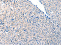 The image on the left is immunohistochemistry of paraffin-embedded Human cervical cancer tissue using CSB-PA288592(ACOT8 Antibody) at dilution 1/20, on the right is treated with fusion protein. (Original magnification: ×200)