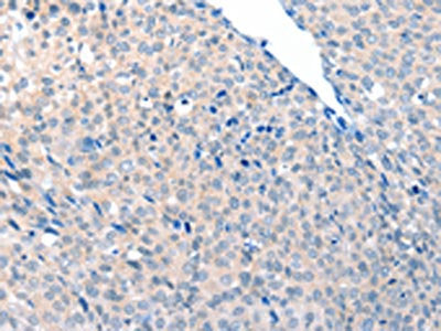The image on the left is immunohistochemistry of paraffin-embedded Human cervical cancer tissue using CSB-PA288592(ACOT8 Antibody) at dilution 1/20, on the right is treated with fusion protein. (Original magnification: ×200)