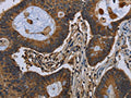 The image on the left is immunohistochemistry of paraffin-embedded Human colon cancer tissue using CSB-PA288891(FGF18 Antibody) at dilution 1/40, on the right is treated with fusion protein. (Original magnification: ×200)