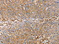 The image on the left is immunohistochemistry of paraffin-embedded Human breast cancer tissue using CSB-PA289722(GFAP Antibody) at dilution 1/25, on the right is treated with fusion protein. (Original magnification: ×200)