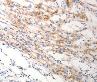 Immunohistochemical analysis of paraffin-embedded Human lung cancer tissue using at dilution 1/0.